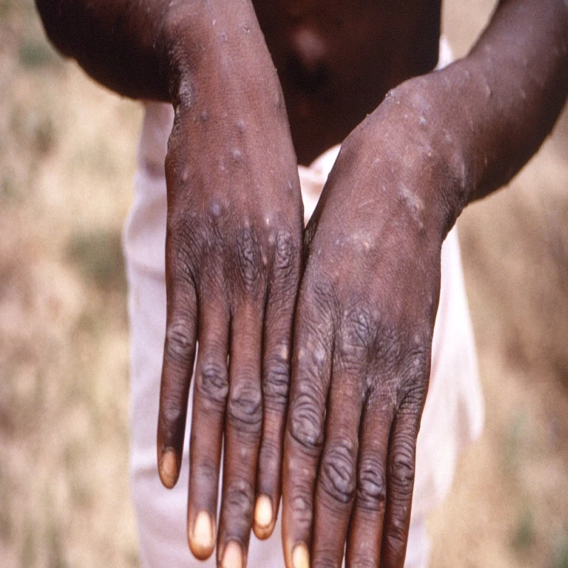 the-most-serious-monkeypox-disease-in-britain