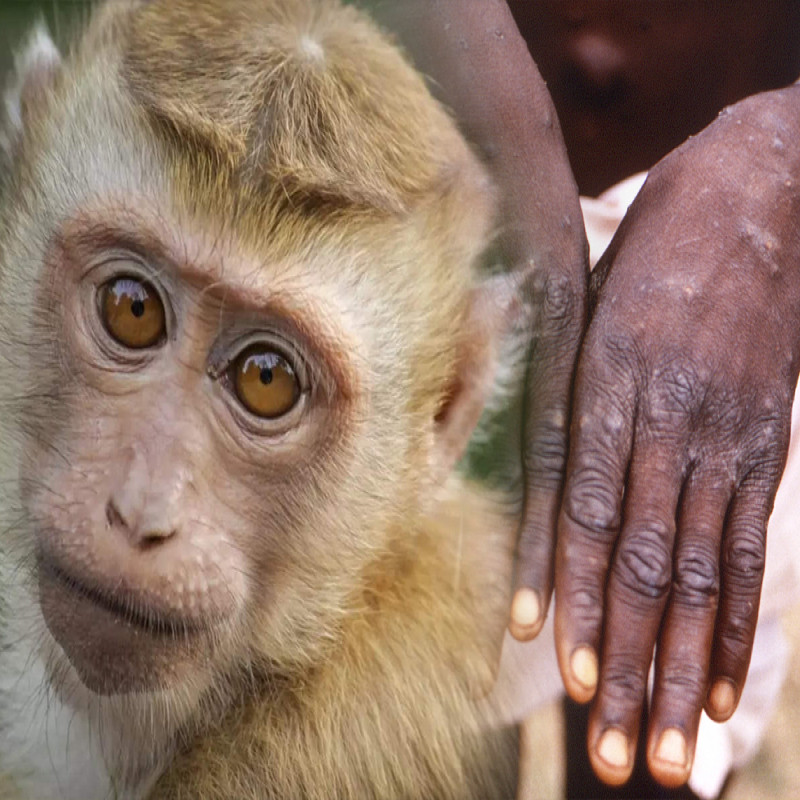 monkeybox-disease-has-also-spread-in-sri-lanka..!-first-identified-person