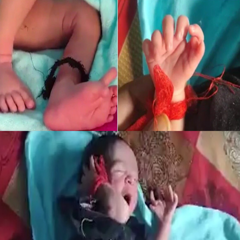 miracle-baby-girl-born-with-26-fingers