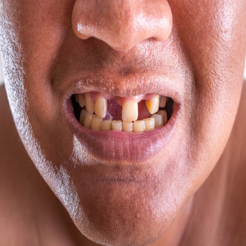 major-problem-faced-by-sri-lankans:-12-percent-have-lost-their-teeth-completely