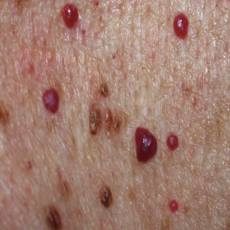 virus-transmitted-to-children-in-colombo:-parents-beware