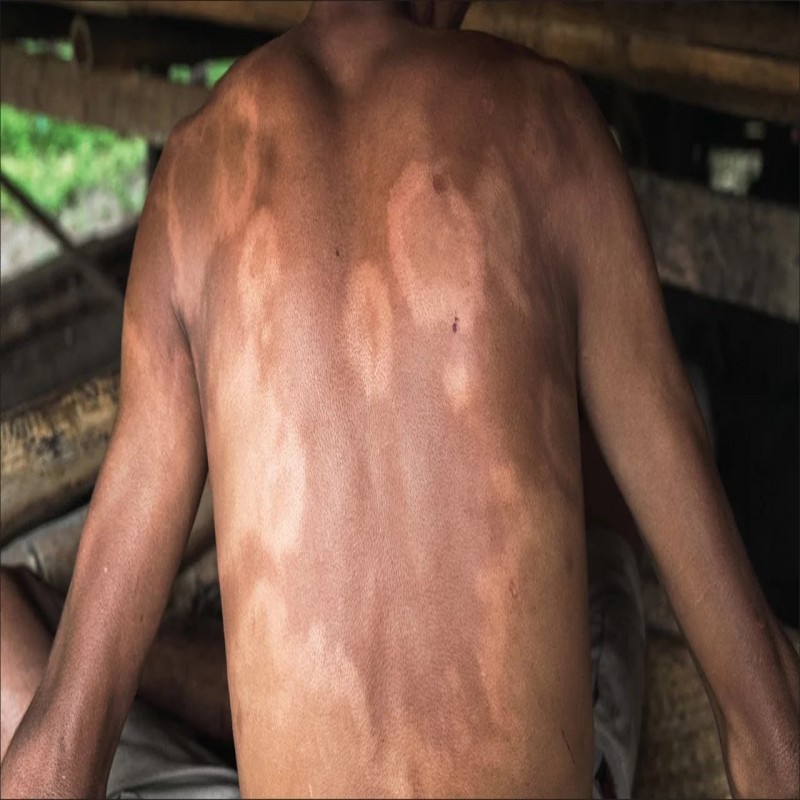 leprosy-cases-in-the-country-have-increased-dramatically---special-measures-to-help-them-get-treatment