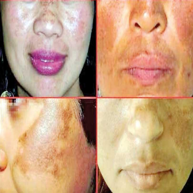 whitening-cream-effects