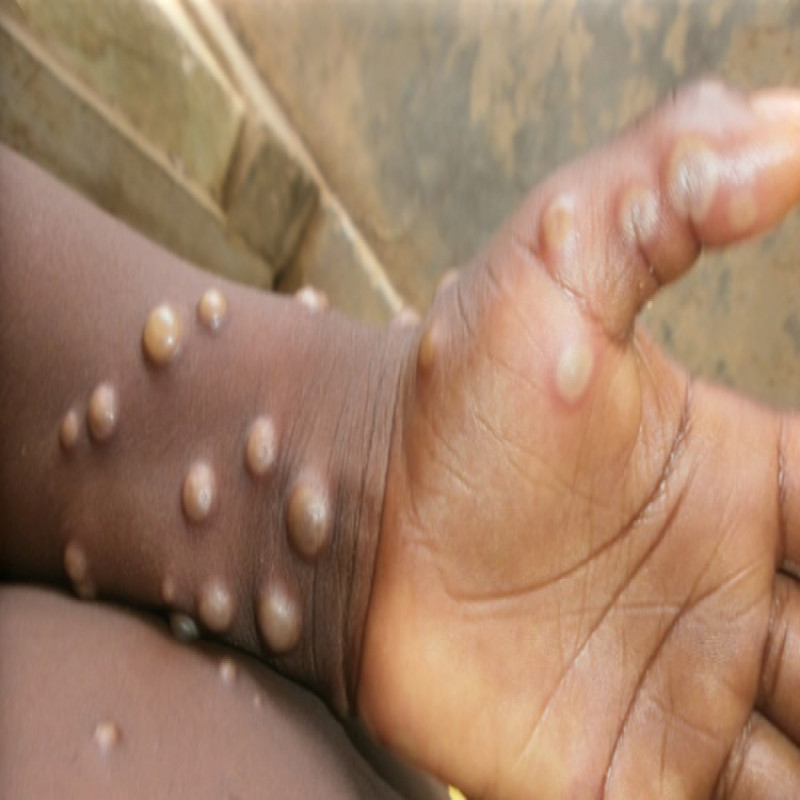 18,700-monkeypox-cases-reported-in-africa:-540-deaths