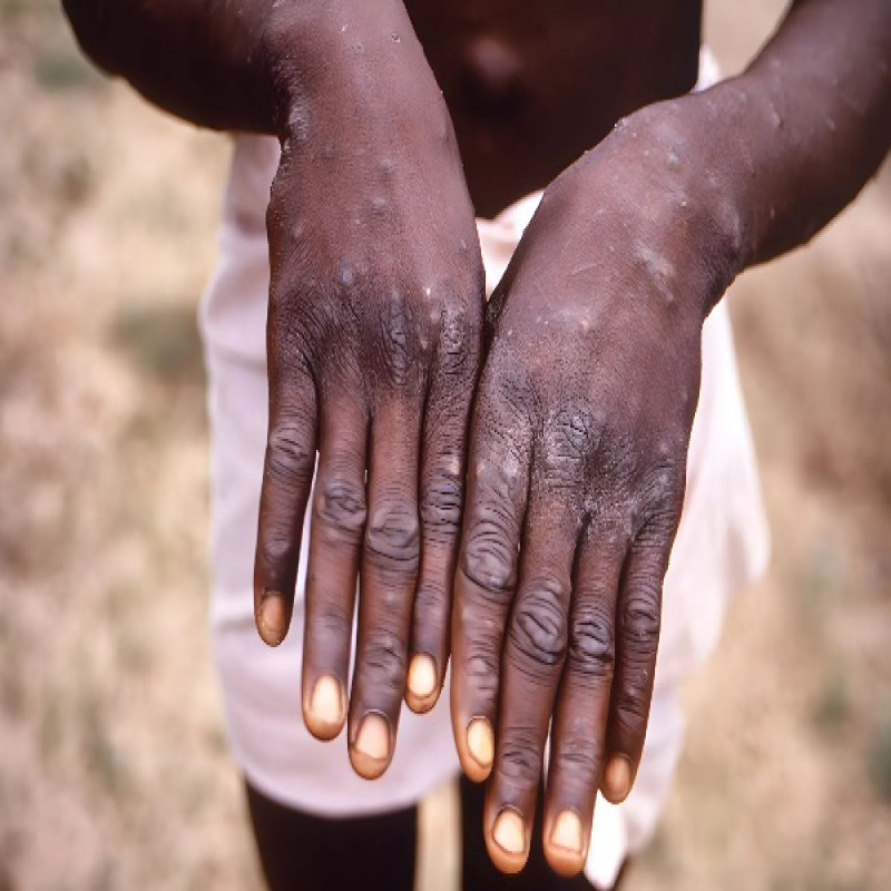monkey-fever-on-the-rise-in-african-countries-–-who-approves-vaccine